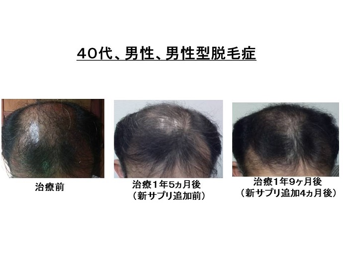 円形脱毛症　病院""
